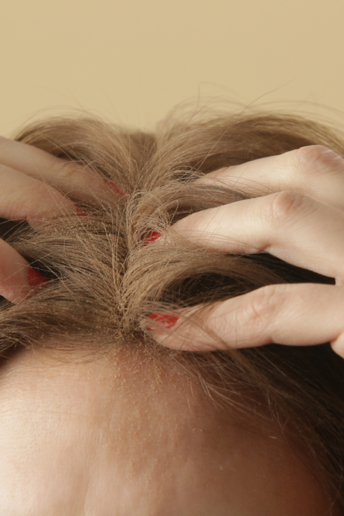 dry scalp