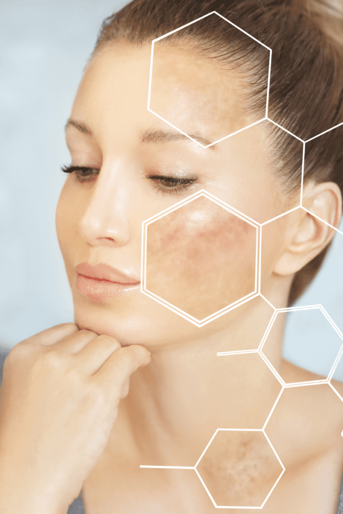 hyperpigmentation treatment